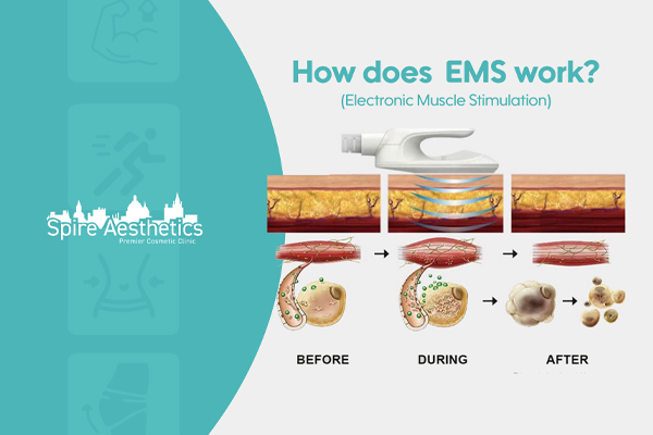 EMS treatment for post pregnancy weight loss treatment Waverley