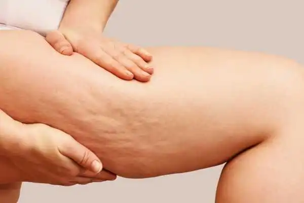 Image of woman showing leg with cellulite Waverley
