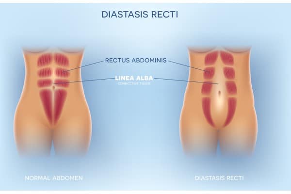 What Non-Surgical Options Are Available for Diastasis Recti Waverley?
