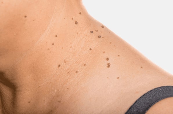 Are you looking for easy skin tag removal Waverley - then contact Spire today!