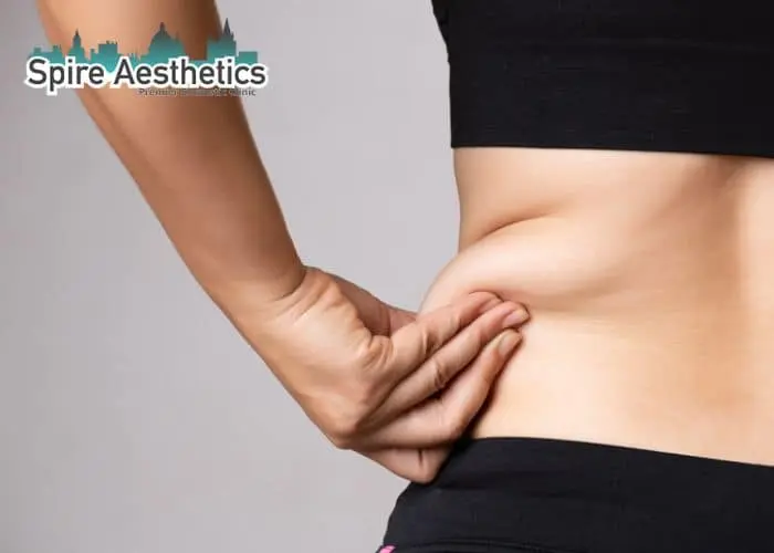 Image of woman pinching fat on their hips Waverley. Fat Freezing treatment