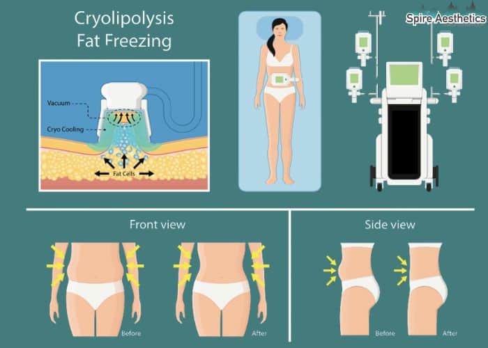 Image of diet and fat freezing combined for best results for Spire Aesthetics Waverley