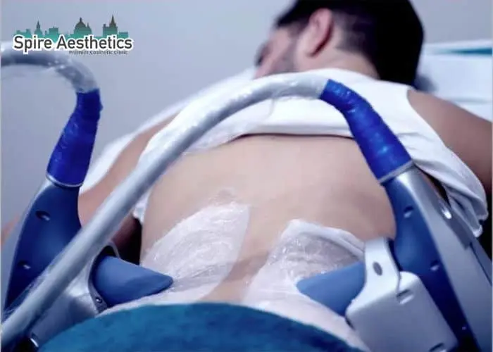 Man having fat freezing treatment done on love handles before a competitions Waverley to create a sculpted look.