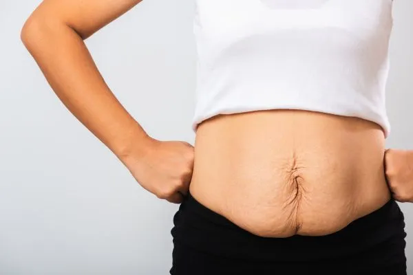 Image of a woman's stomach after weight loss with sagging skin following a gastric band Waverley