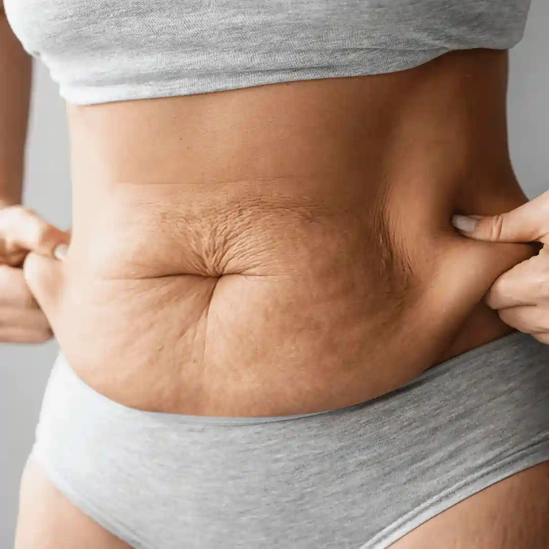 Is It Normal to Have Loose Skin After Pregnancy Waverley?